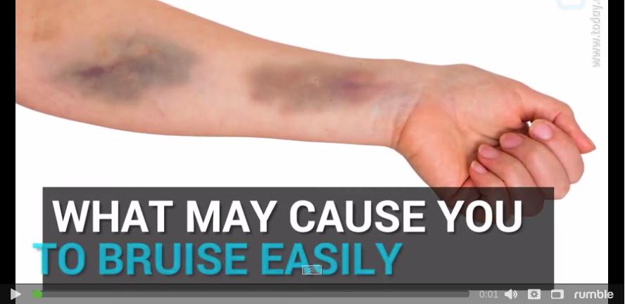 Do You Get Bruises Easily Here Are 7 Things That Might Be To Blame   Bruise 