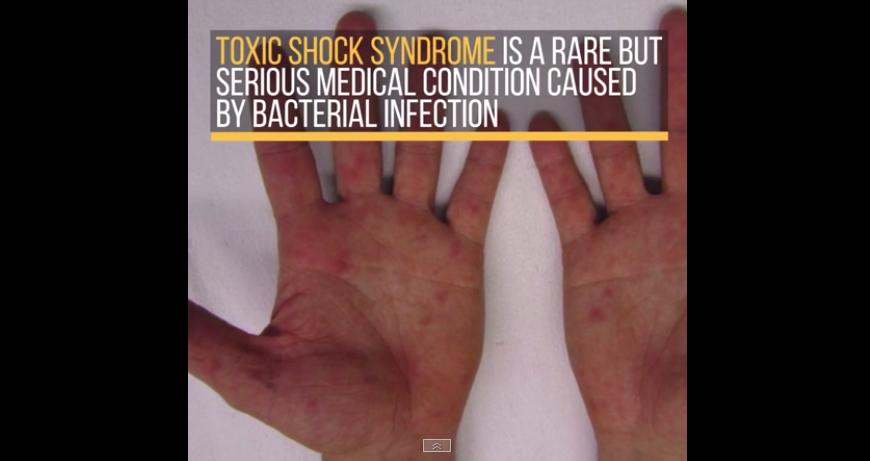 What Are The Symptoms Of Toxic Shock From Tampons